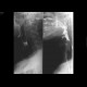Laryngeal dysphagia: RF - Fluoroscopy